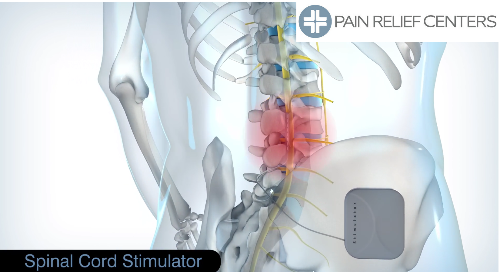 Spinal Cord Stimulation Procedure